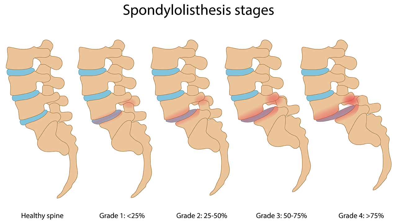 spondilolistezis